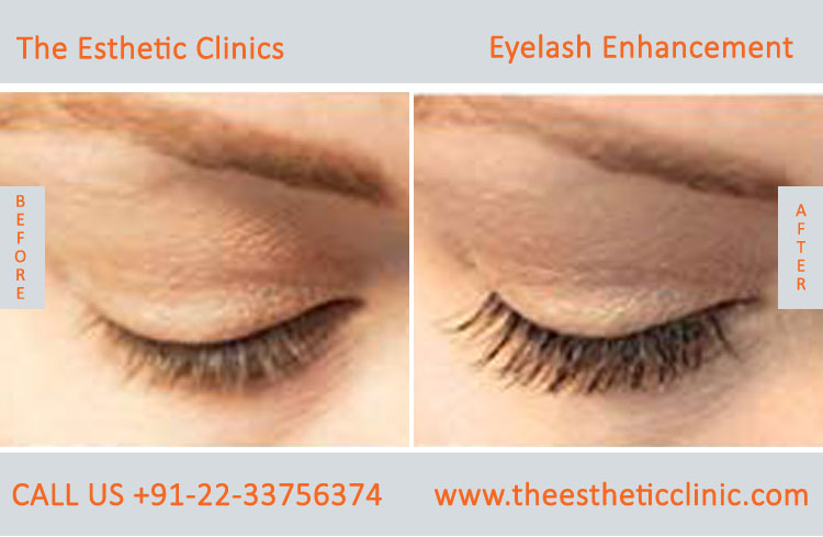 Eyelash Enhancement Surgery, Latisse Eyelash Treatment before after photos in mumbai india (4)